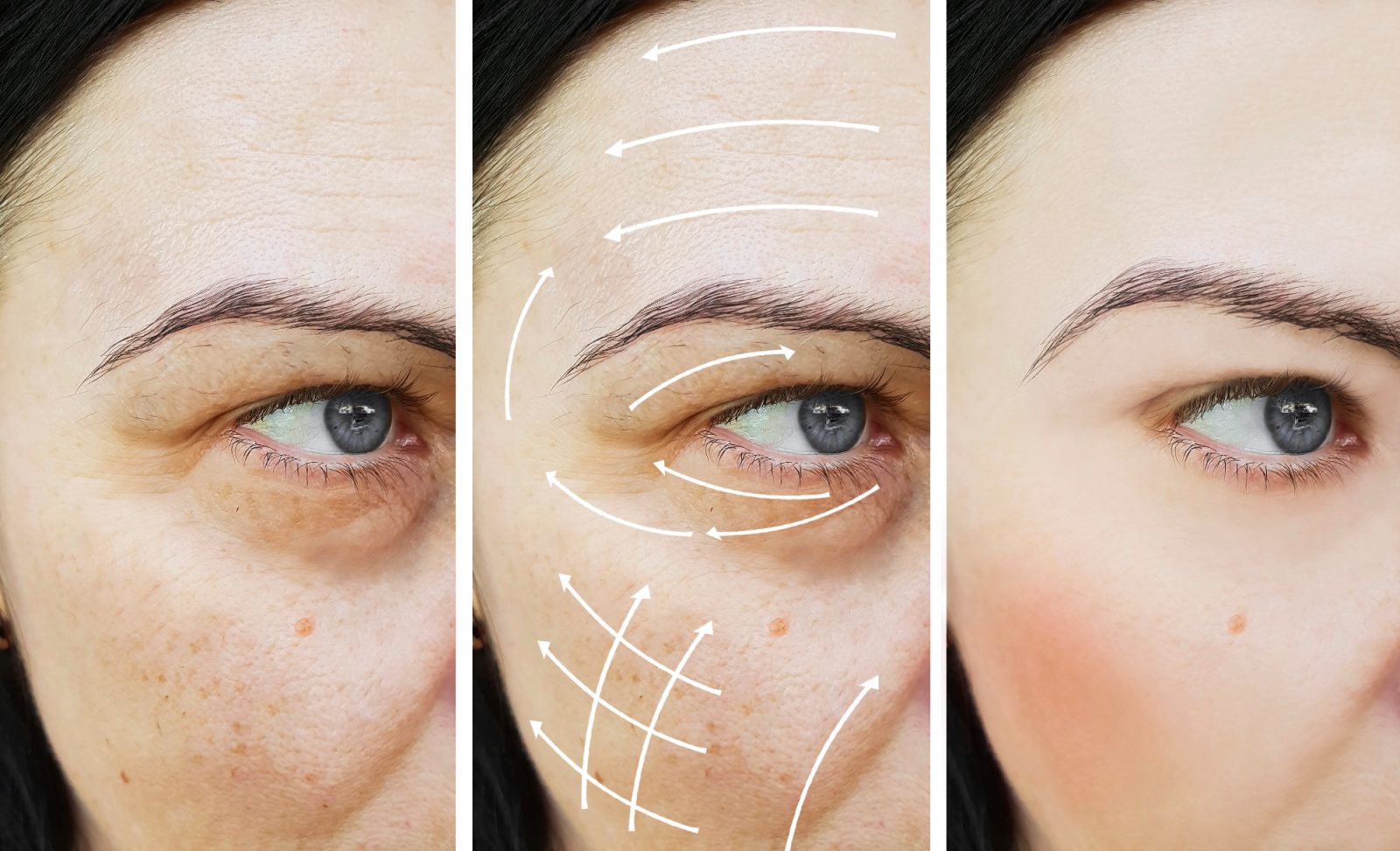 Blefaroplastika je še kako pomagala moji babici